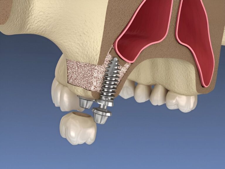 Sinus Lift in Broomfield, CO | Sinus Lift Near Me