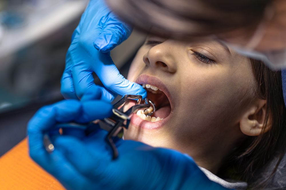 top myths about dental sealants facts you should know