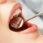 composite fillings fix chipped tooth