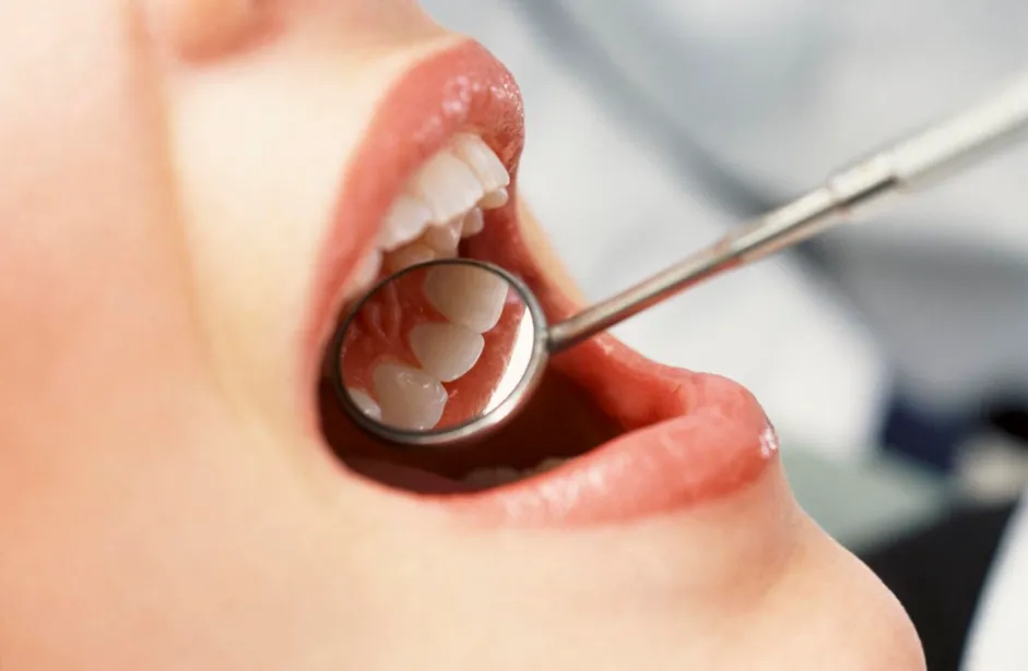 composite fillings fix chipped tooth