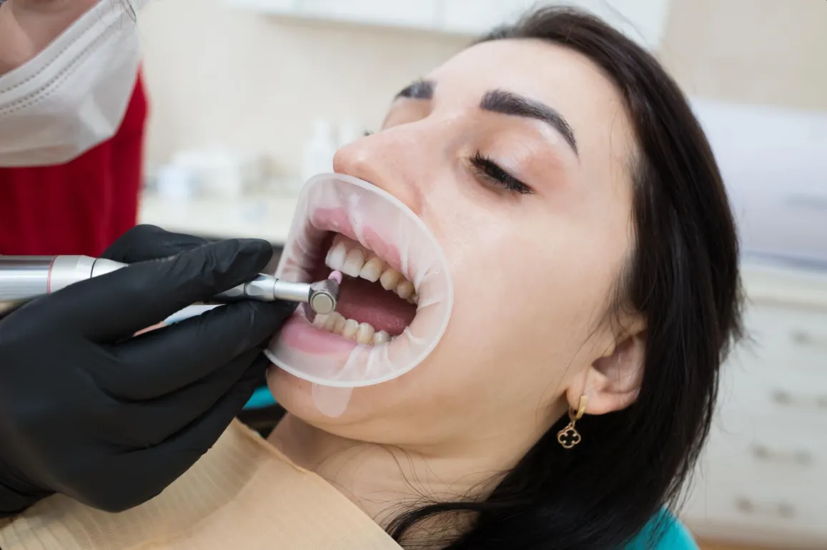 keep composite fillings stain free